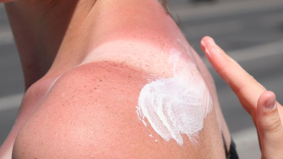 Warning of sunburn: “Tanmaxxing” trend: experts warn of sunburn