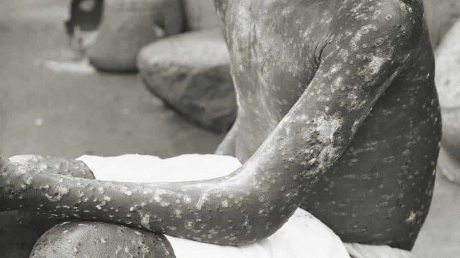 Colonial-era viruses: Genetic evidence: Europeans brought smallpox to America