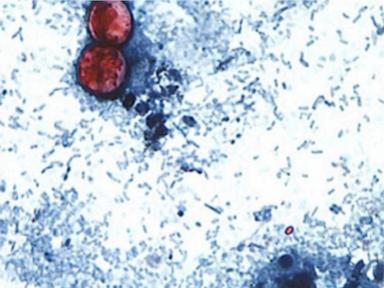 Most cases reported in Michigan; CDC count lags behind state health departments