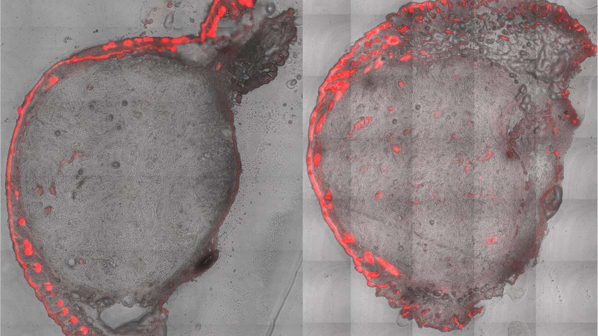 Le traitement du cancer de la peau par les micro-nœuds résout deux problèmes